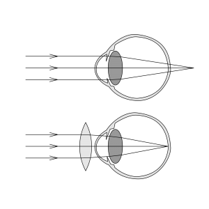 2000px-Hypermetropia.svg