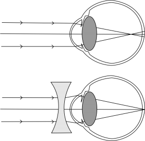 2000px-Myopia-2-3.svg
