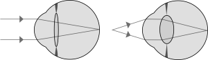 Focus_in_an_eye2